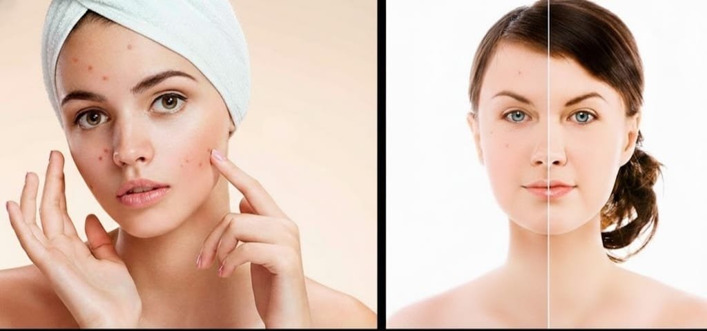 Acne and Makeup Don’t Let Cosmetics Create Breakouts