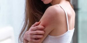 Stop Stress Rash Quickly and Effectively