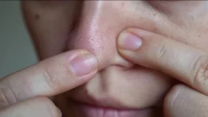 How to Rid of Nose Blackheads Permanently: Expert Backed Solutions