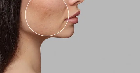 How to Get Rid of Acne Scars Effective Solutions That Work