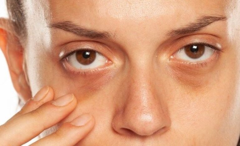 Top Non Surgical Solutions For Under Eye Hollows