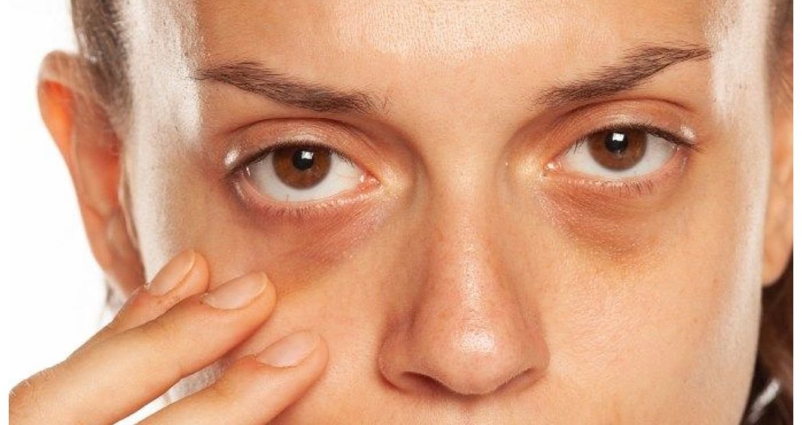Top Non Surgical Solutions For Under Eye Hollows