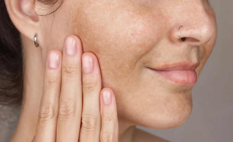 Why Your Pigmentation Is Getting Darker Even After Using Sunscreen 