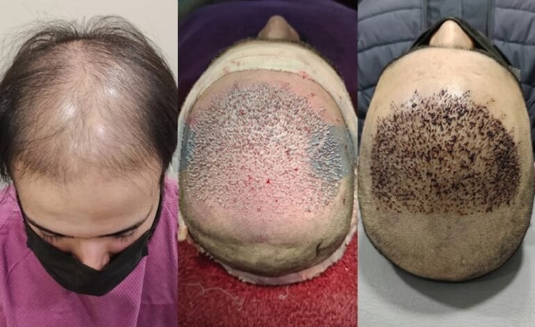 Hair Transplant Success Rate and Results