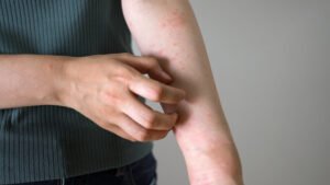 Why Heat Rash Happens and Does It Go Away Naturally?