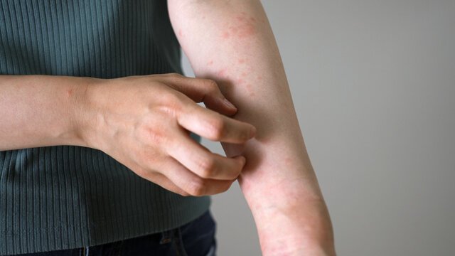 Why Heat Rash Happens and Does It Go Away Naturally?