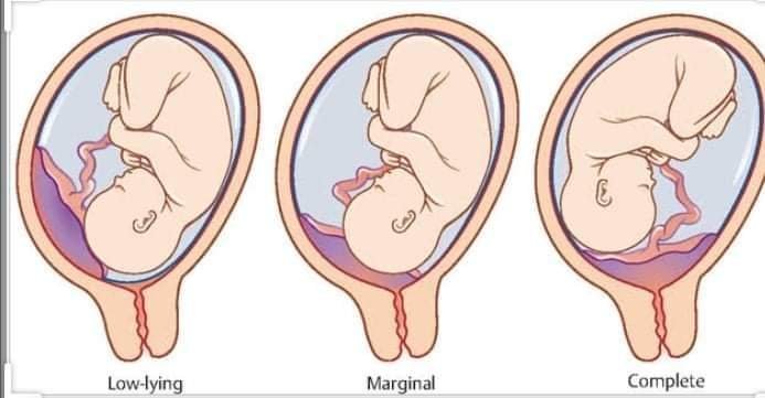 Is Antepartum Haemorrhage Life Threatening and How Is It Treated?