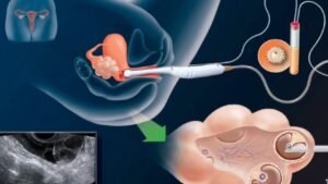 Make Your Dream of Motherhood Come True with Artificial Insemination