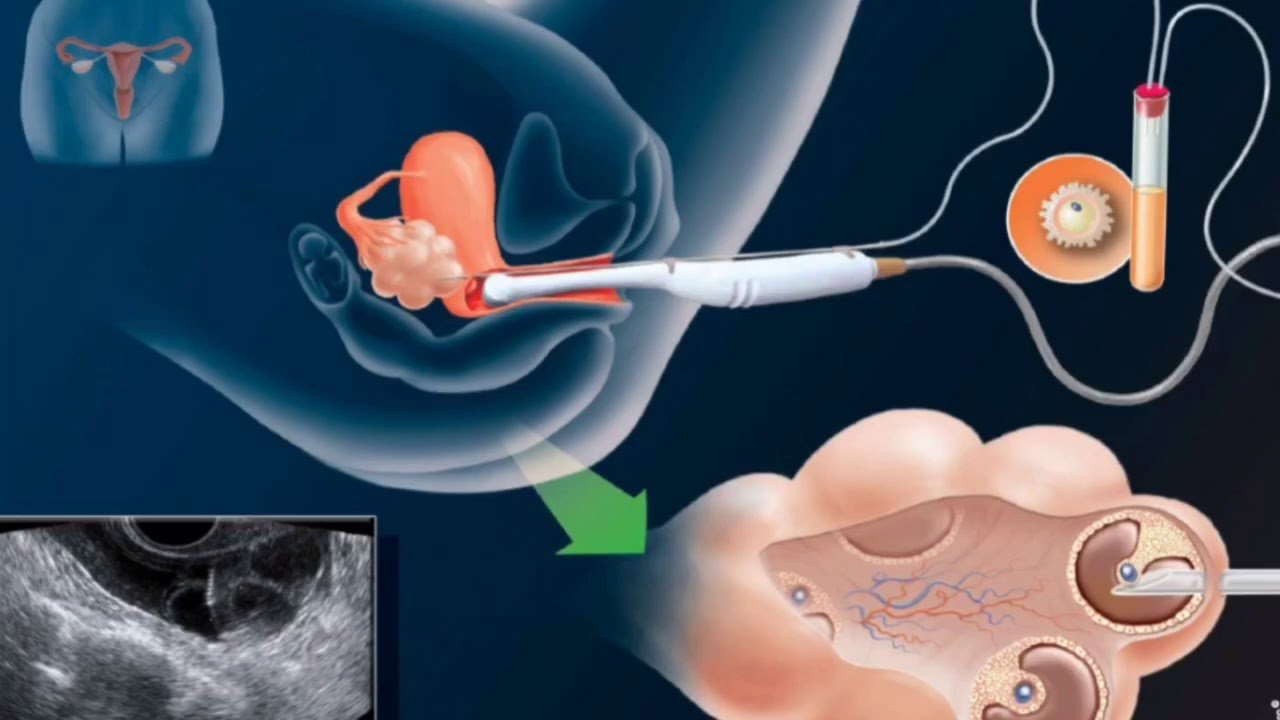 Make Your Dream of Motherhood Come True with Artificial Insemination