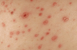 Medical illustration showing chlamydia skin rash symptoms on the body