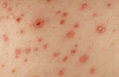 7 Signs Your Skin Rash Could Be Related to Chlamydia