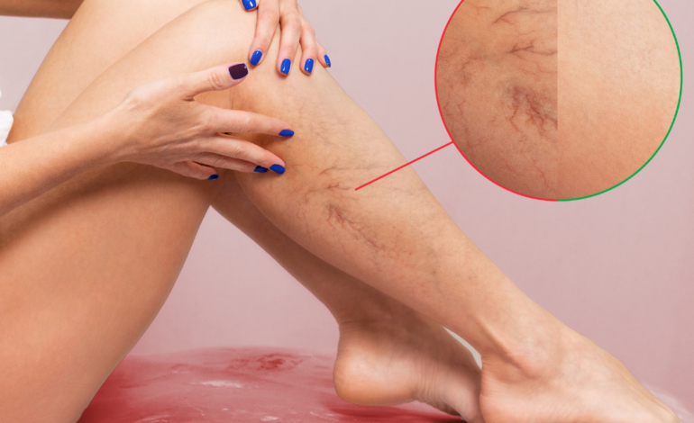 How to Prevent Varicose Veins With Exercise and Diet