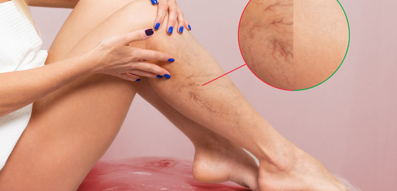 How to Prevent Varicose Veins With Exercise and Diet
